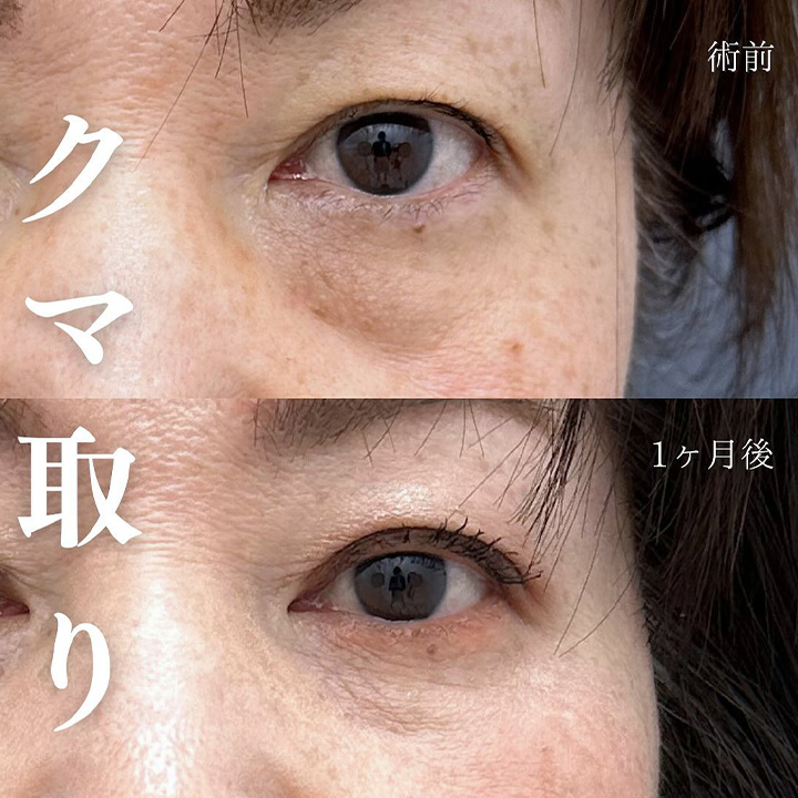 切らない目の下のクマ取り・目の下のたるみ（ふくらみ）取りの症例写真02