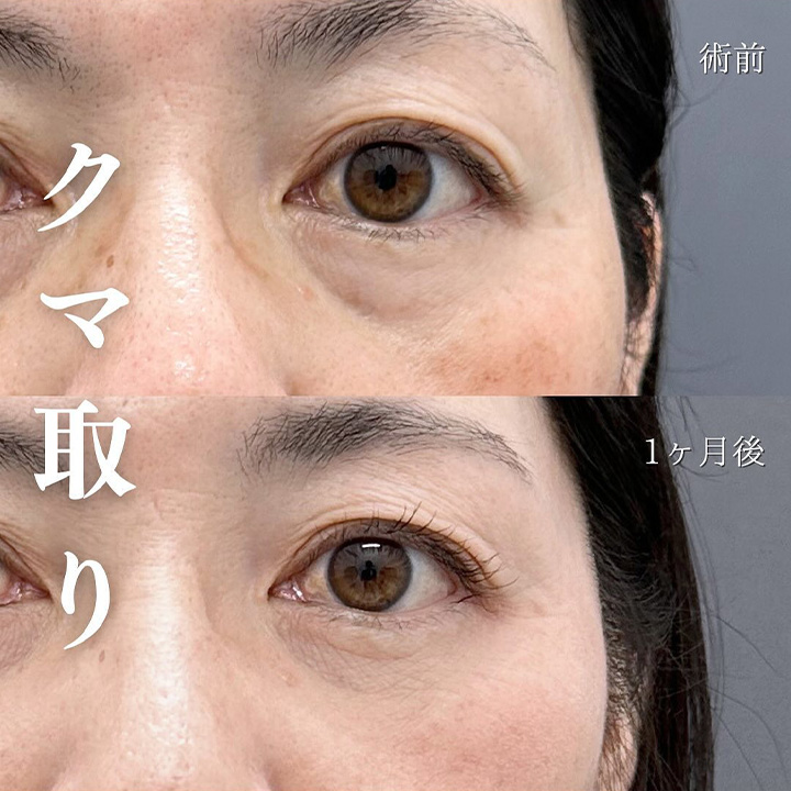 切らない目の下のクマ取り・目の下のたるみ（ふくらみ）取りの症例写真03
