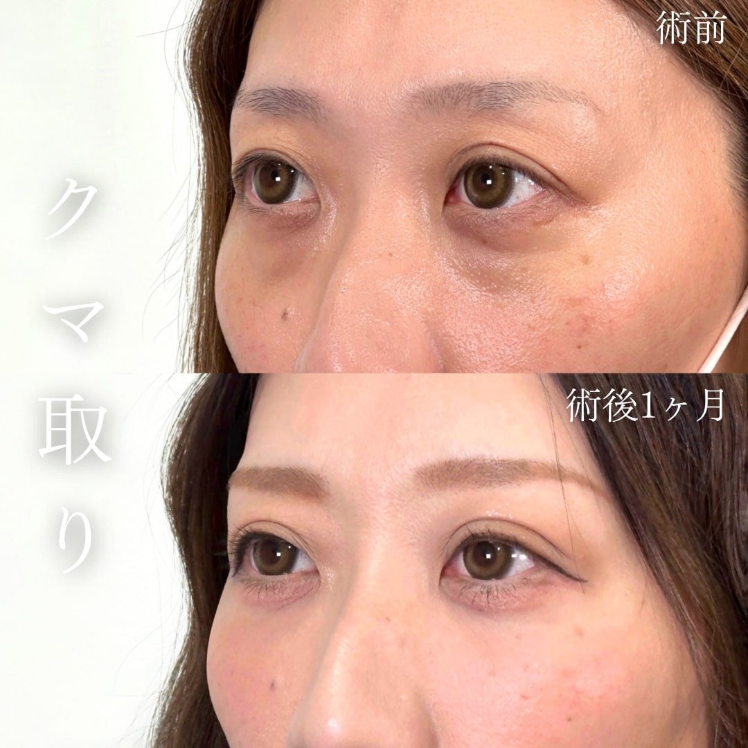 切らない目の下のクマ取り・目の下のたるみ（ふくらみ）取り01