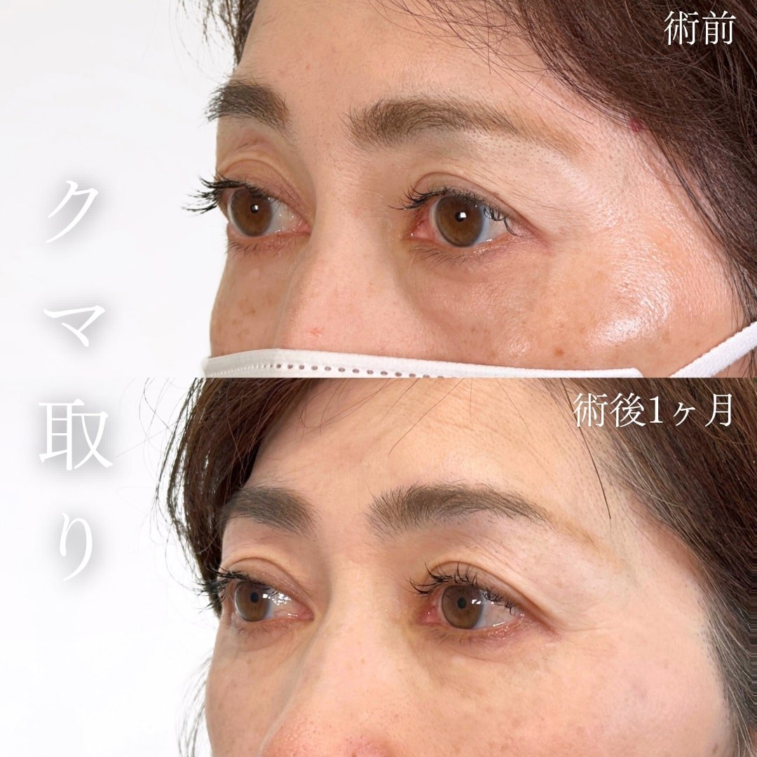 切らない目の下のクマ取り・目の下のたるみ（ふくらみ）取り02