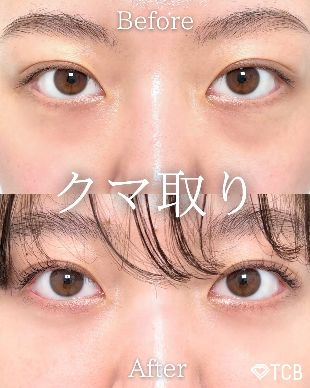 切らない目の下のクマ取り・目の下のたるみ（ふくらみ）取りの症例写真01