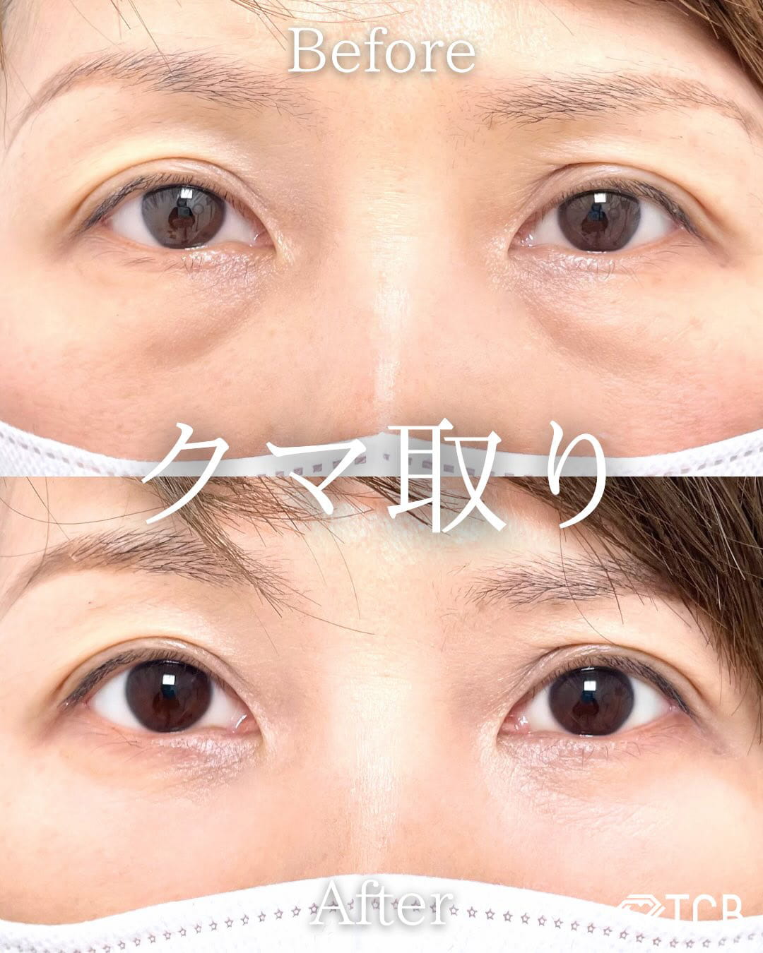 切らない目の下のクマ取り・目の下のたるみ（ふくらみ）取りの症例写真02