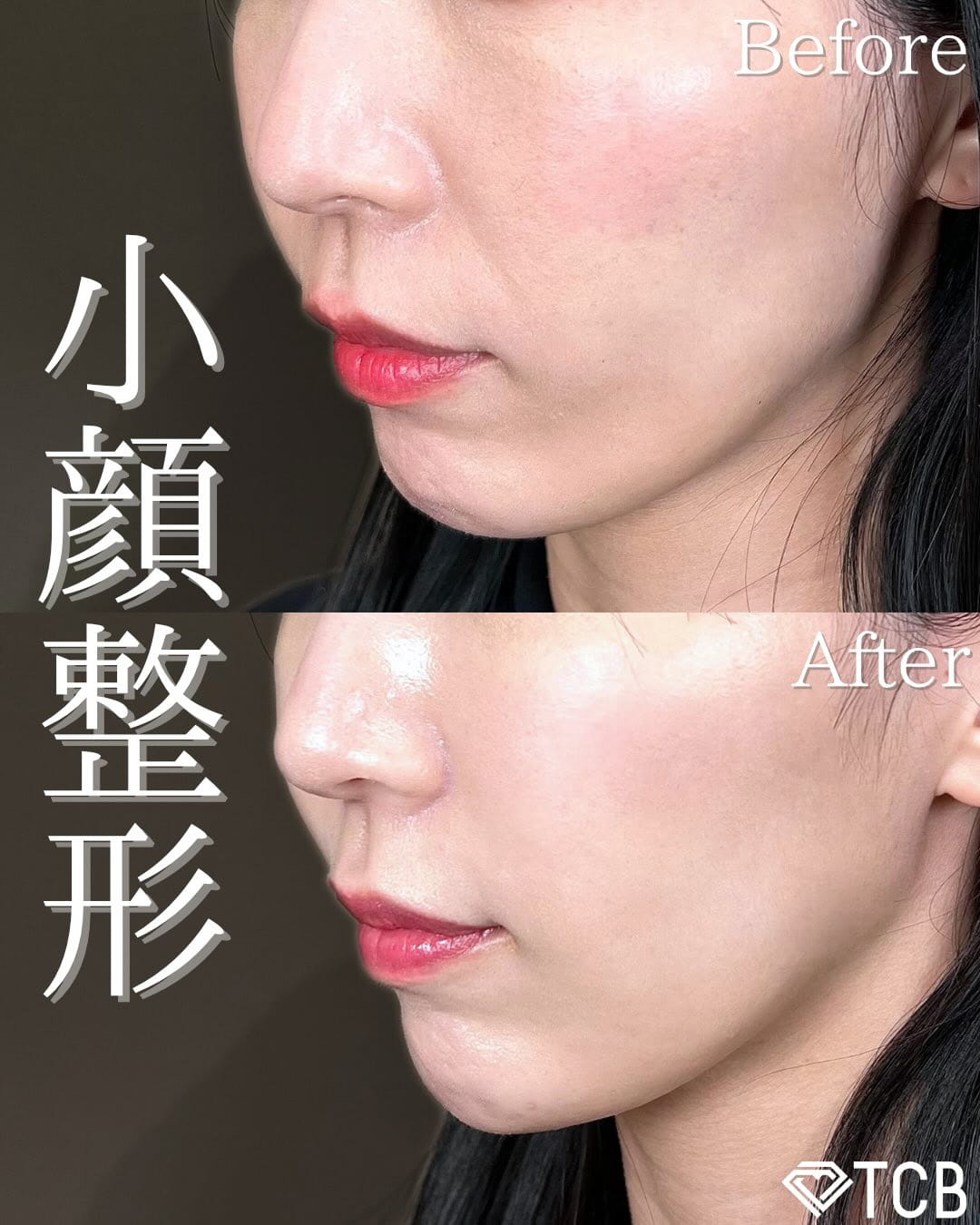 小顔美肌再生の症例写真01