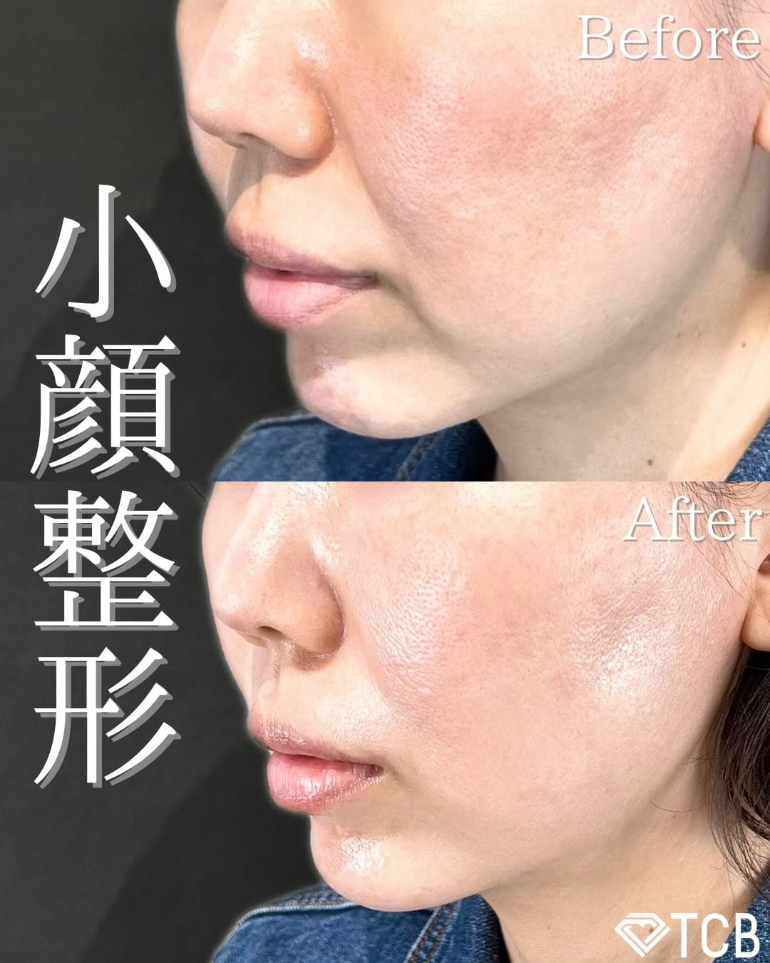 小顔美肌再生の症例写真02