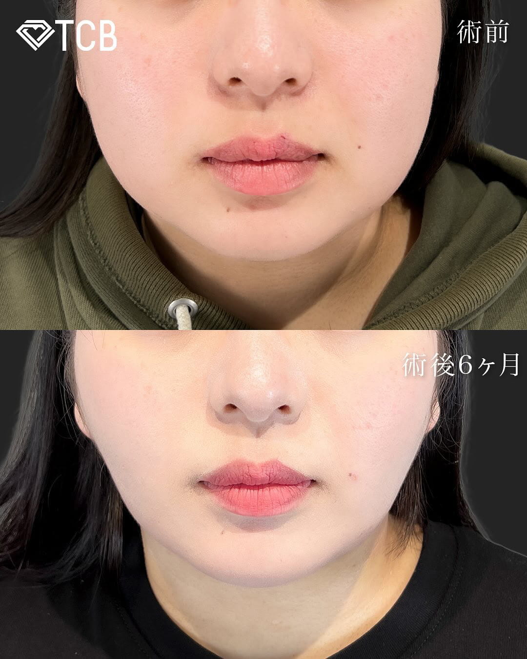 顔の脂肪吸引の症例写真01