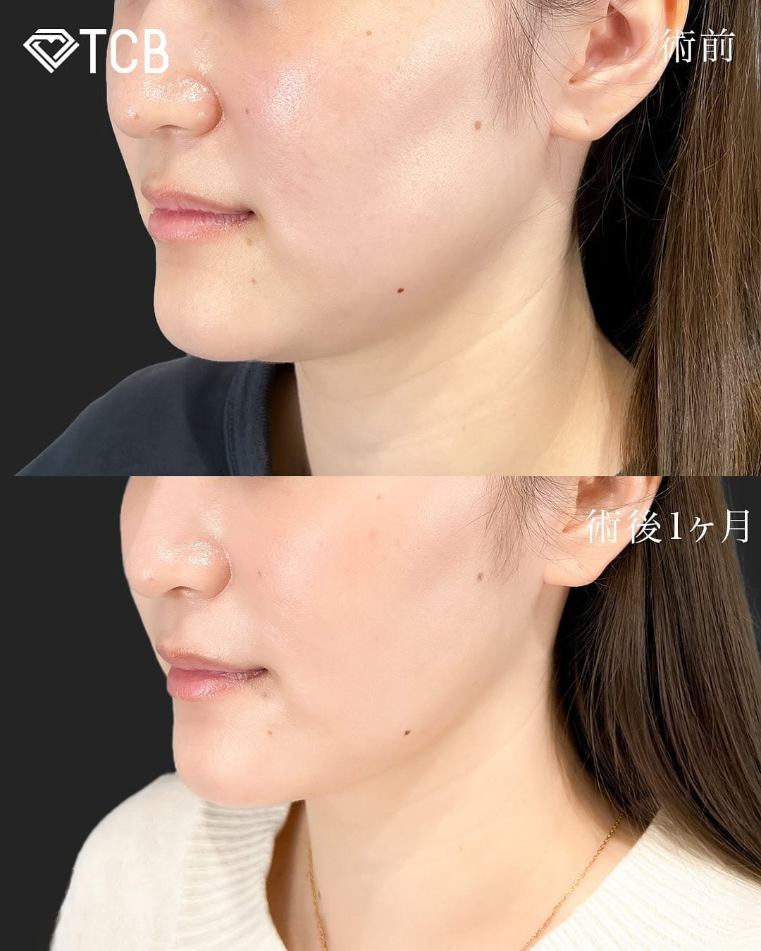 顔の脂肪吸引の症例写真02