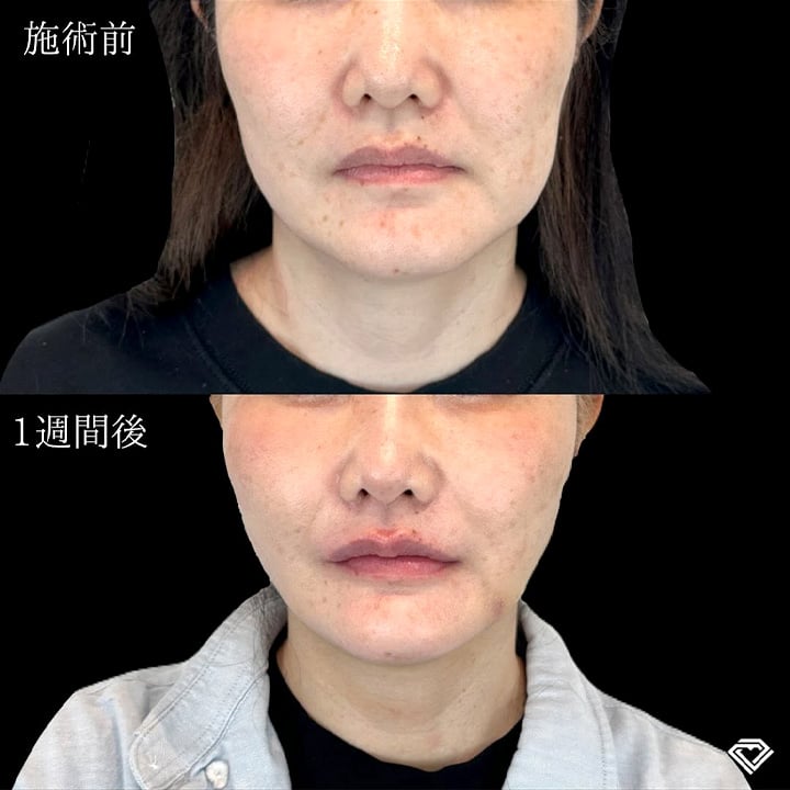 小顔美肌再生の症例写真01