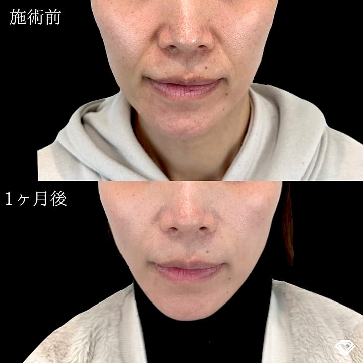 小顔美肌再生の症例写真02