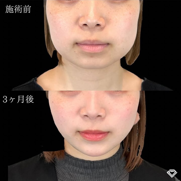 小顔美肌再生の症例写真03