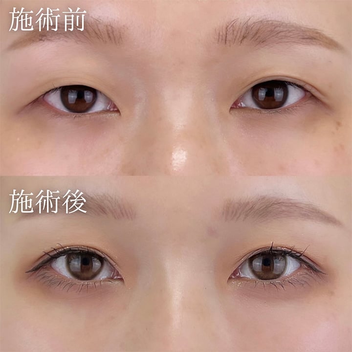 二重埋没の症例写真01