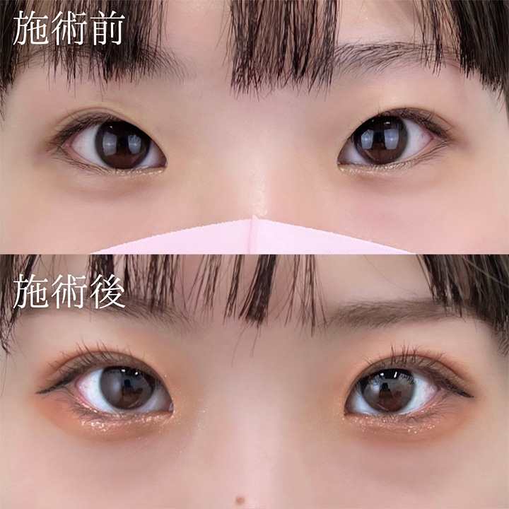 二重埋没の症例写真03