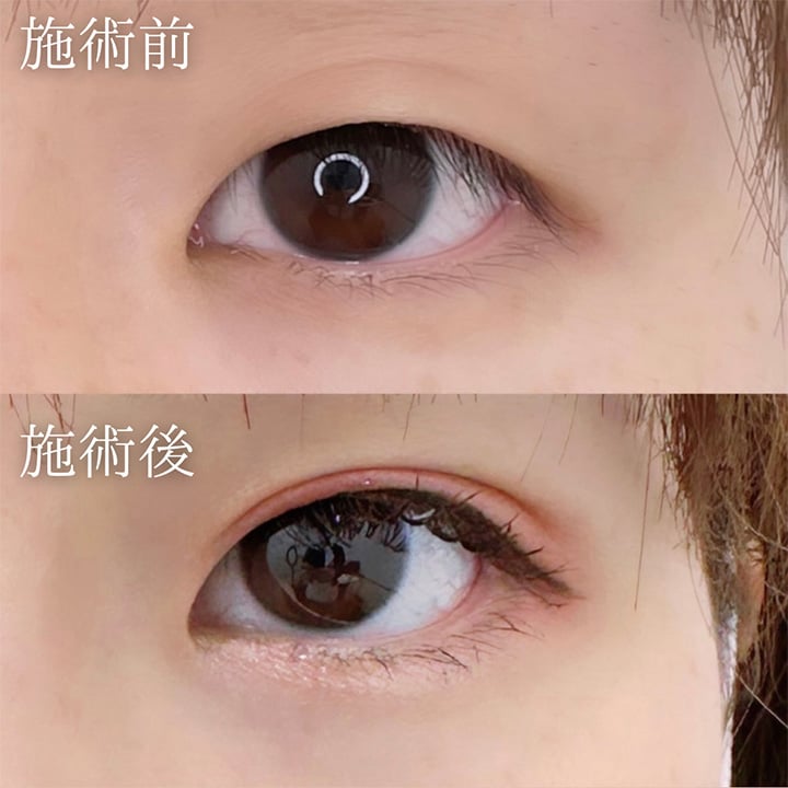 二重埋没の症例写真04