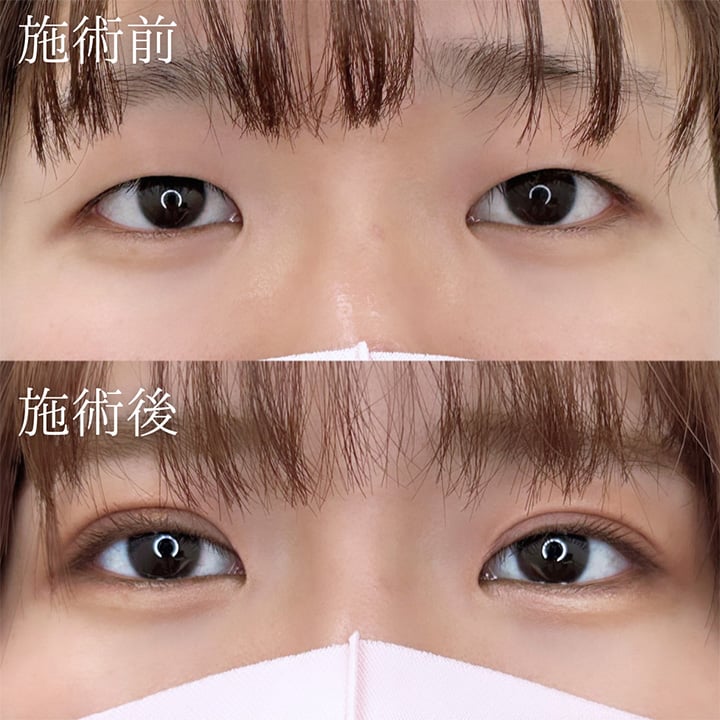 二重埋没の症例写真05