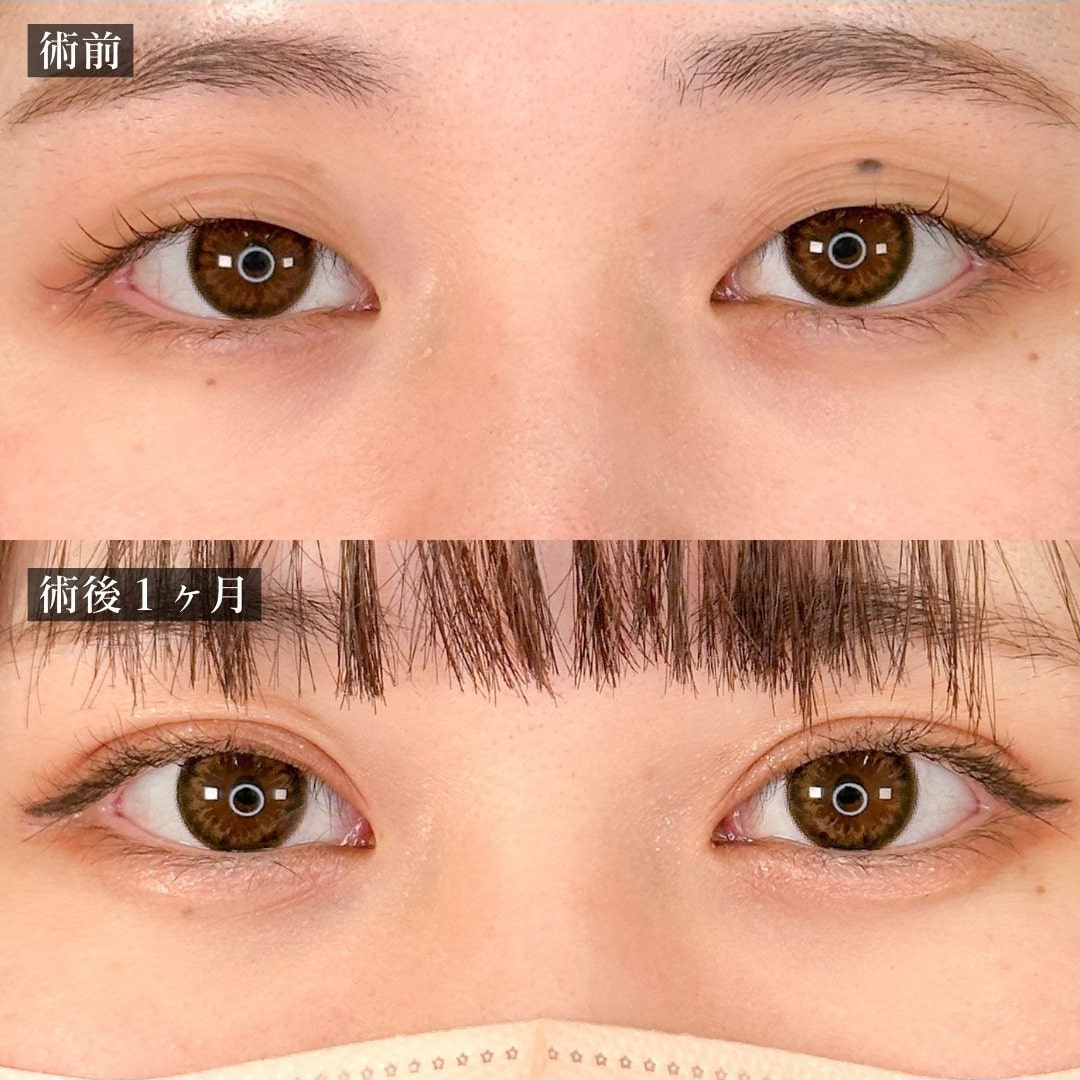 二重埋没の症例写真01