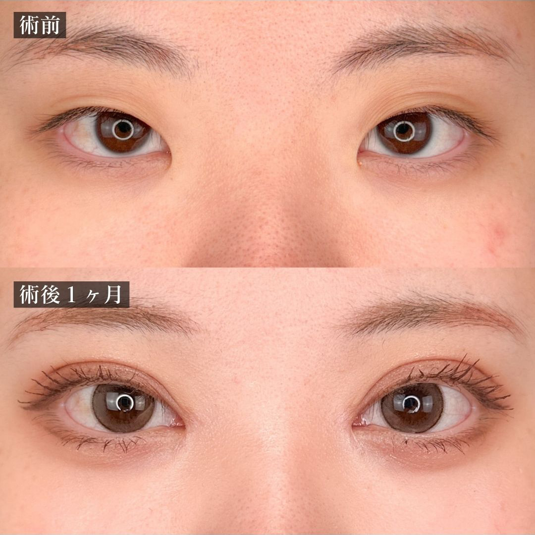 二重埋没の症例写真02