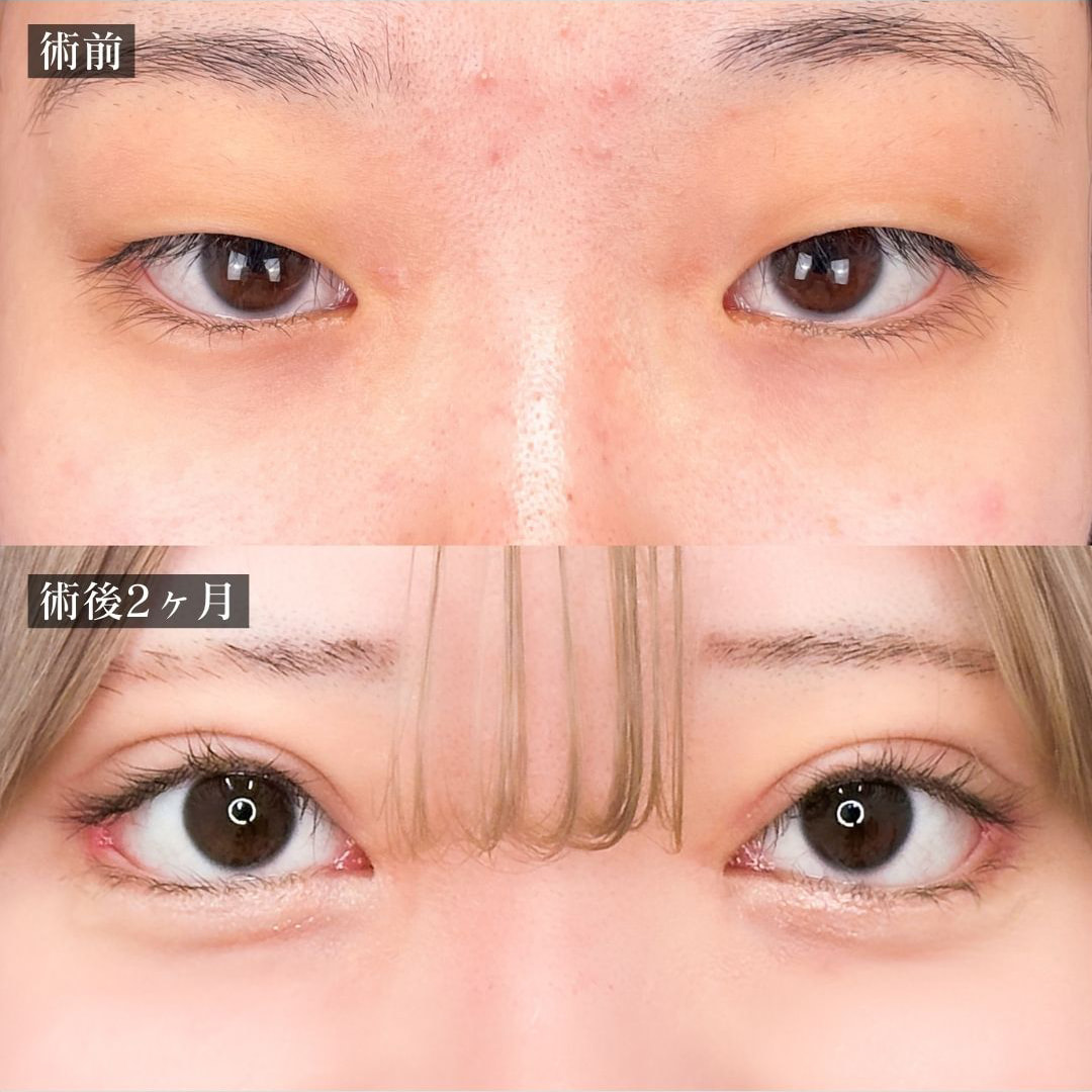 二重切開の症例写真01