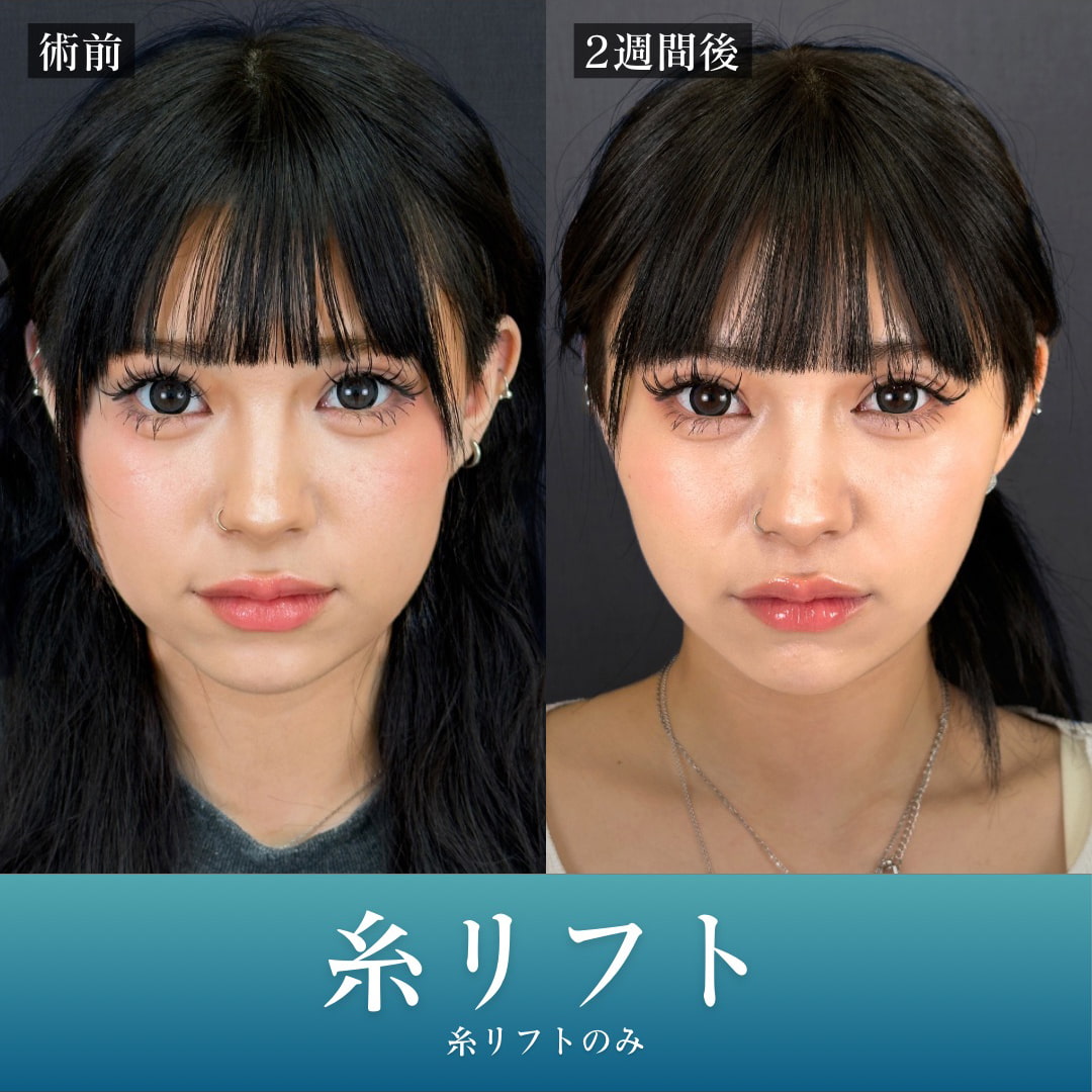 小顔美肌再生の症例写真01