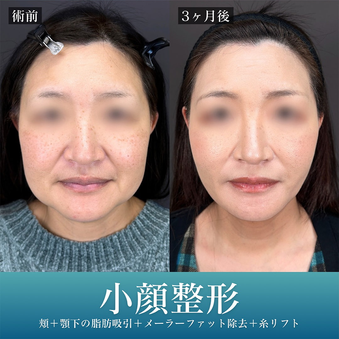 小顔美肌再生の症例写真03