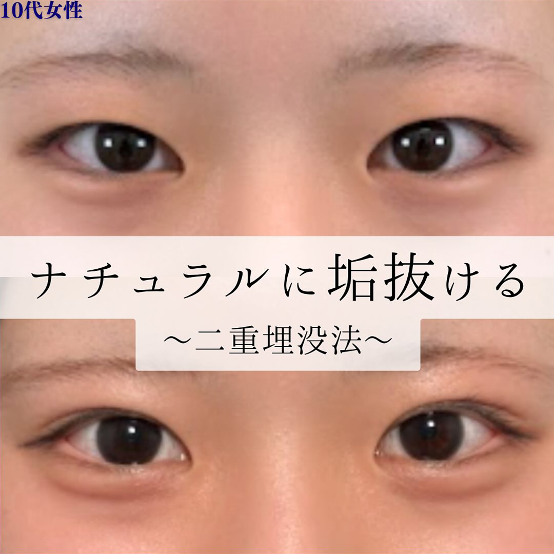 二重埋没の症例写真02