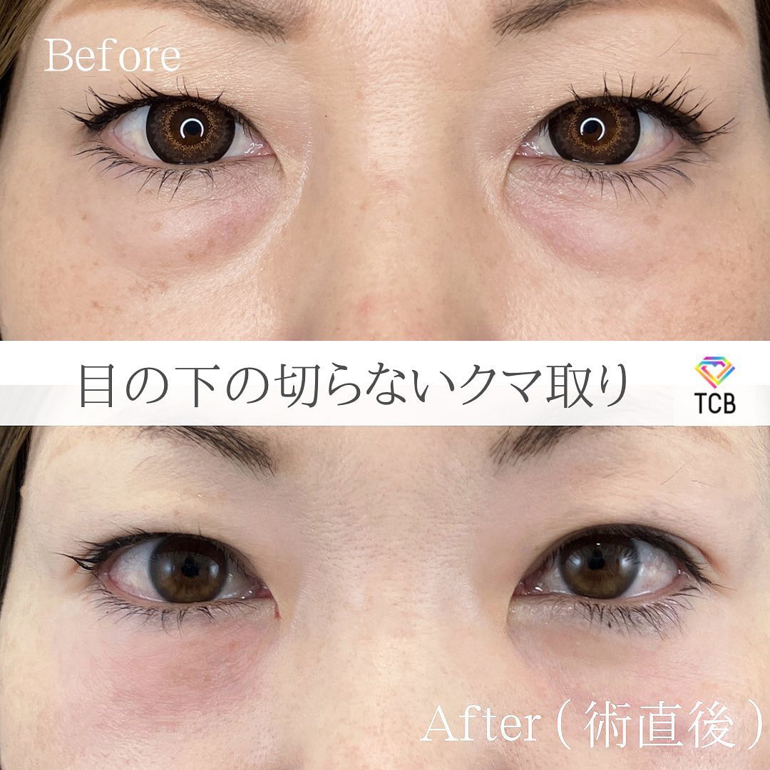 切らない目の下のクマ・たるみ取りの症例写真02
