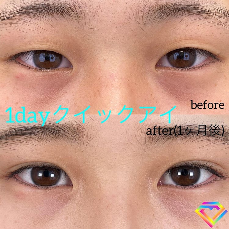 二重埋没の症例写真01