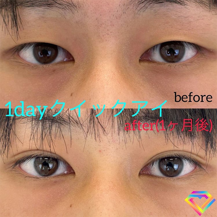 二重埋没の症例写真02