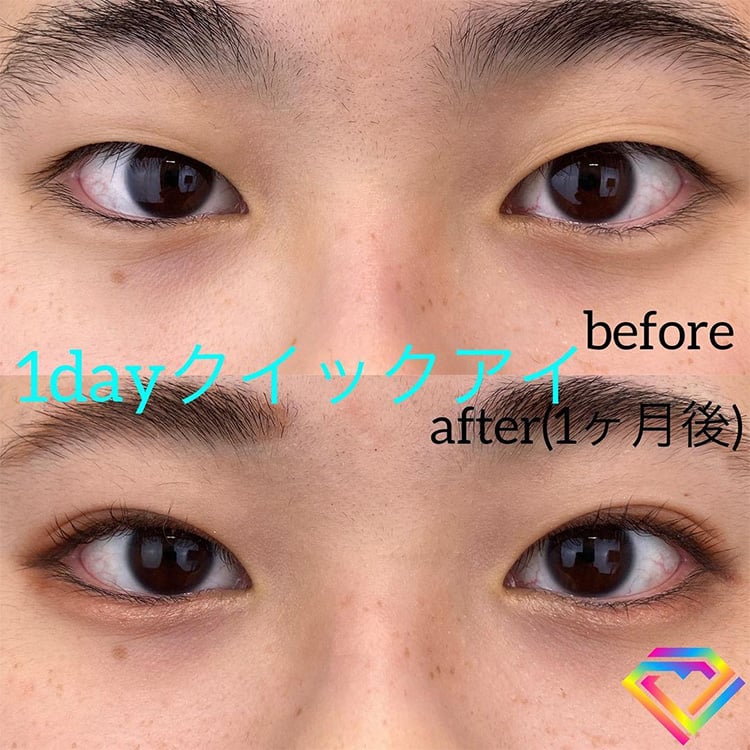 二重埋没の症例写真03