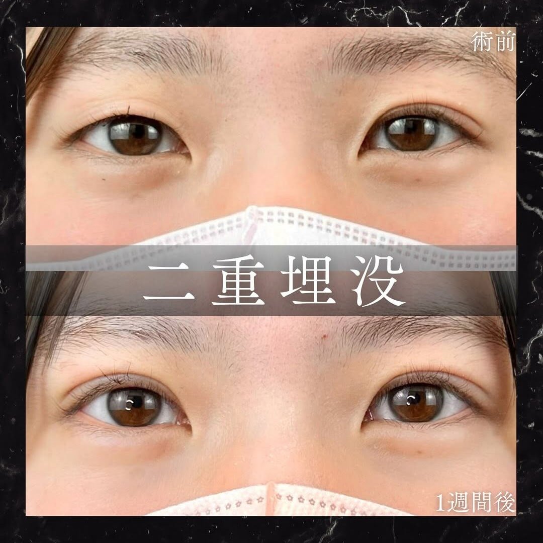 二重埋没の症例写真01