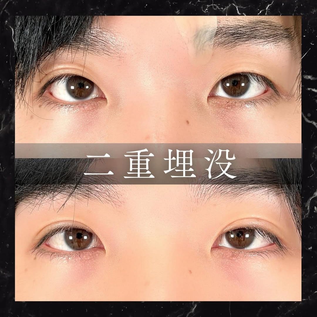 二重埋没の症例写真02