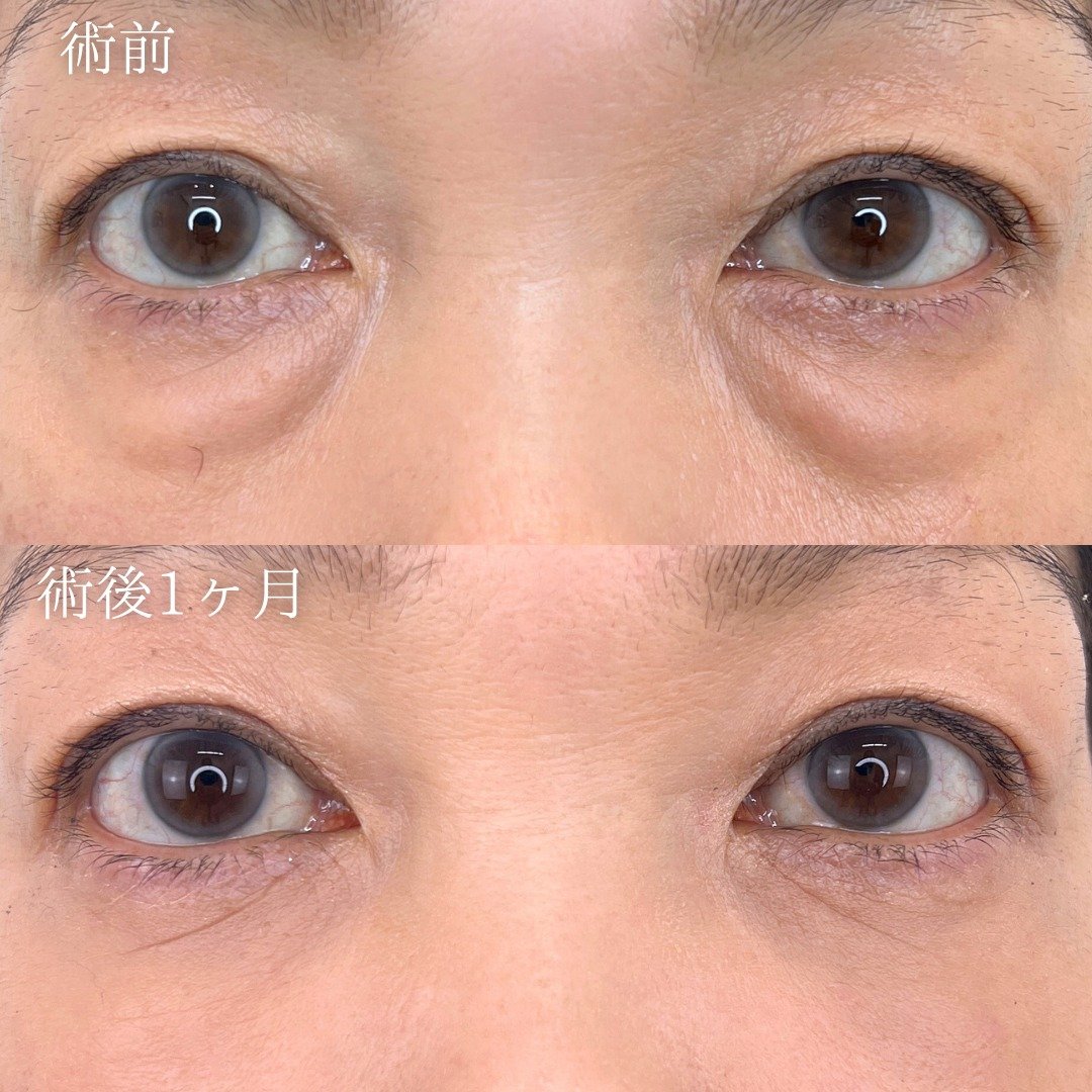切らない目の下のクマ取り・目の下のたるみ（ふくらみ）取りの症例写真02