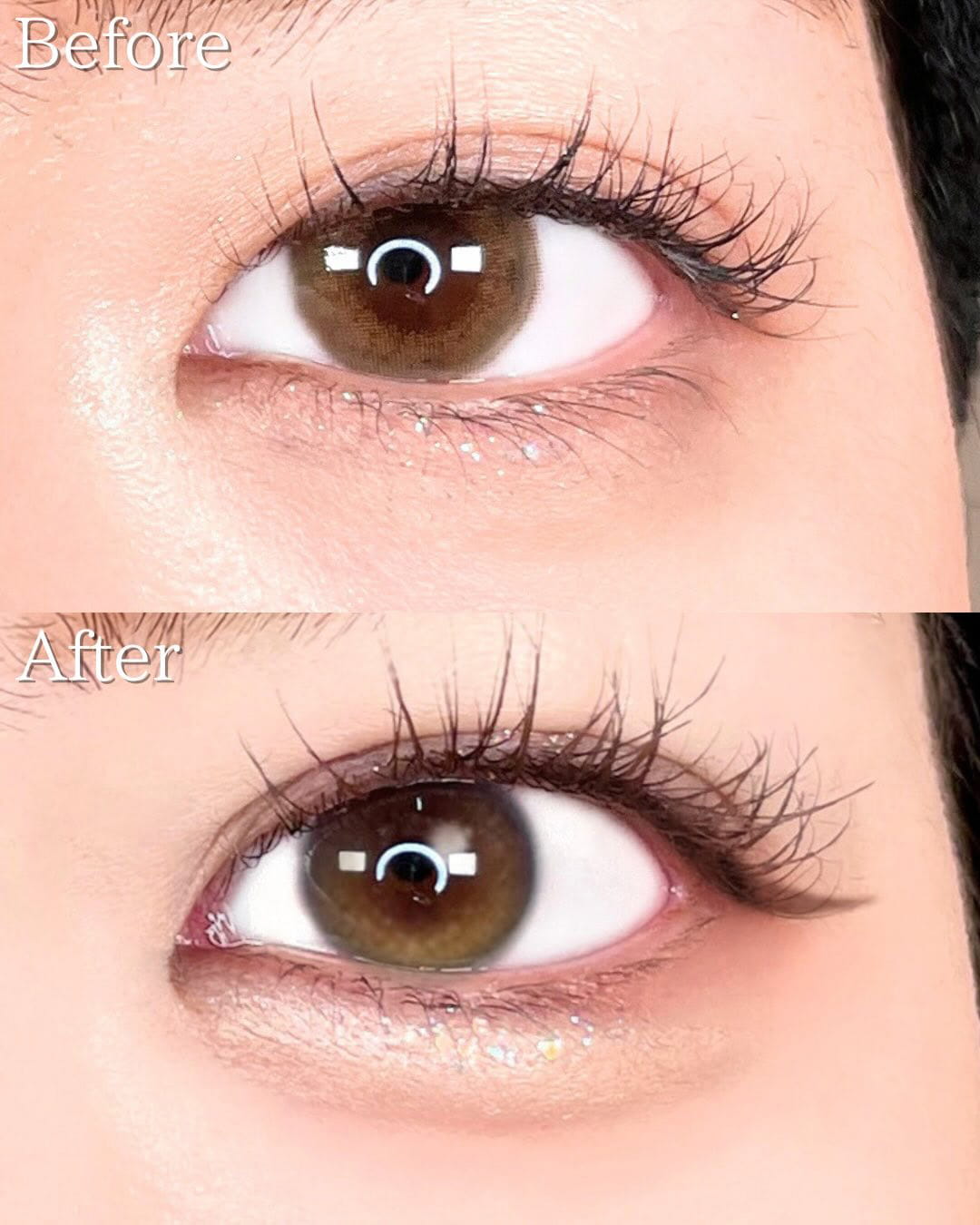 二重埋没の症例写真01