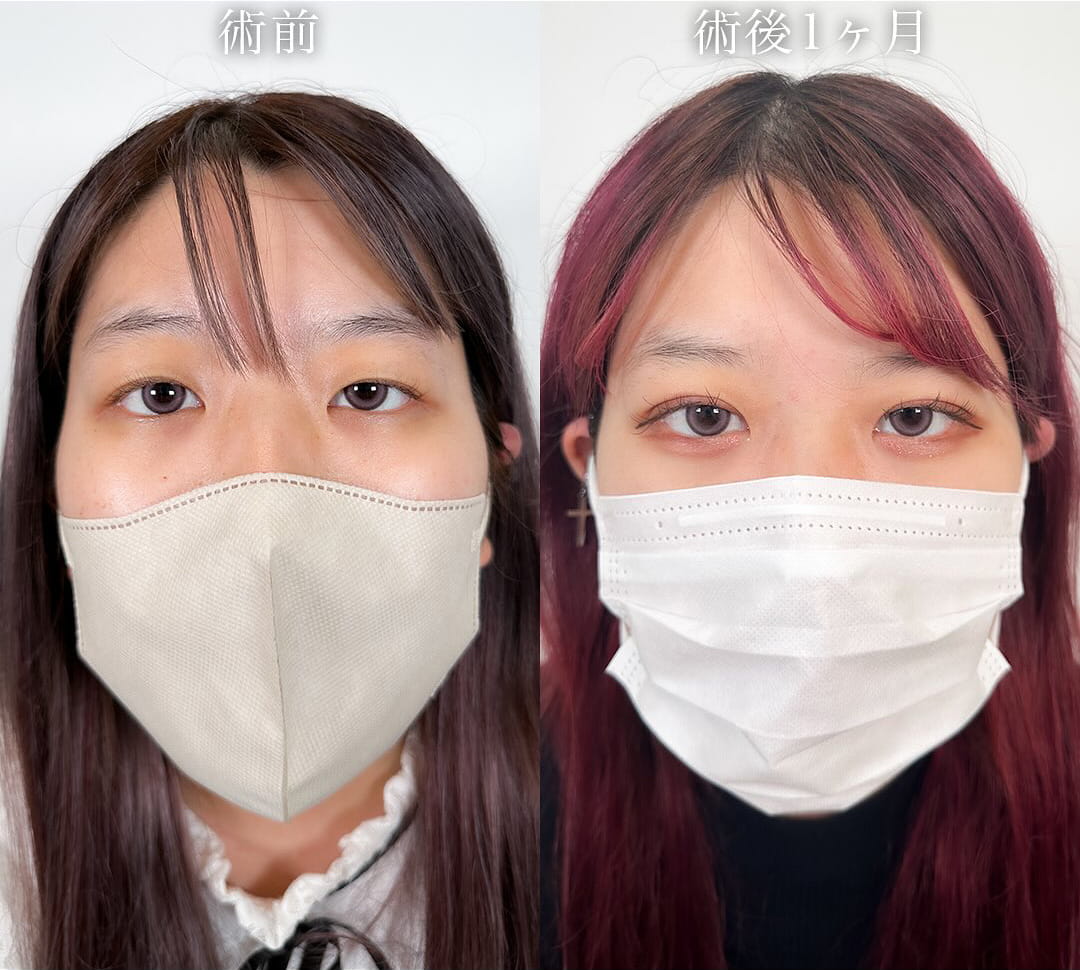 二重埋没の症例写真02