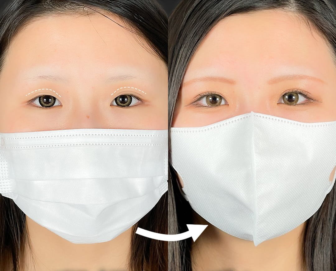 二重埋没の症例写真03