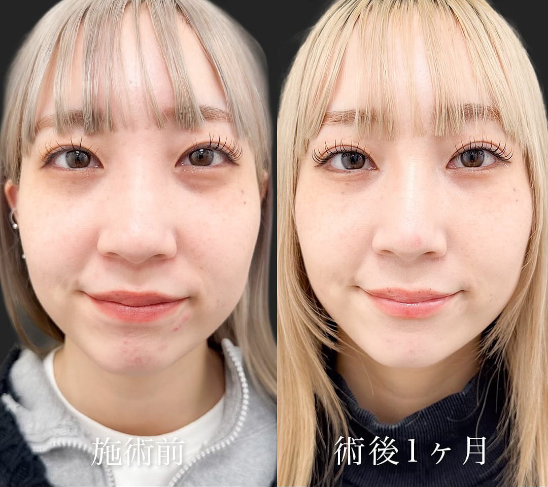 切らない目の下のクマ取り・目の下のたるみ（ふくらみ）取りの症例写真01