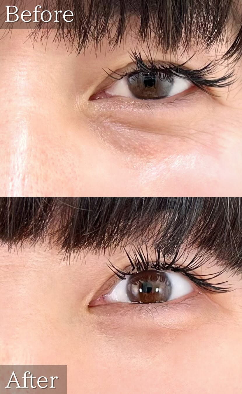 切らない目の下のクマ取り・目の下のたるみ（ふくらみ）取りの症例写真02