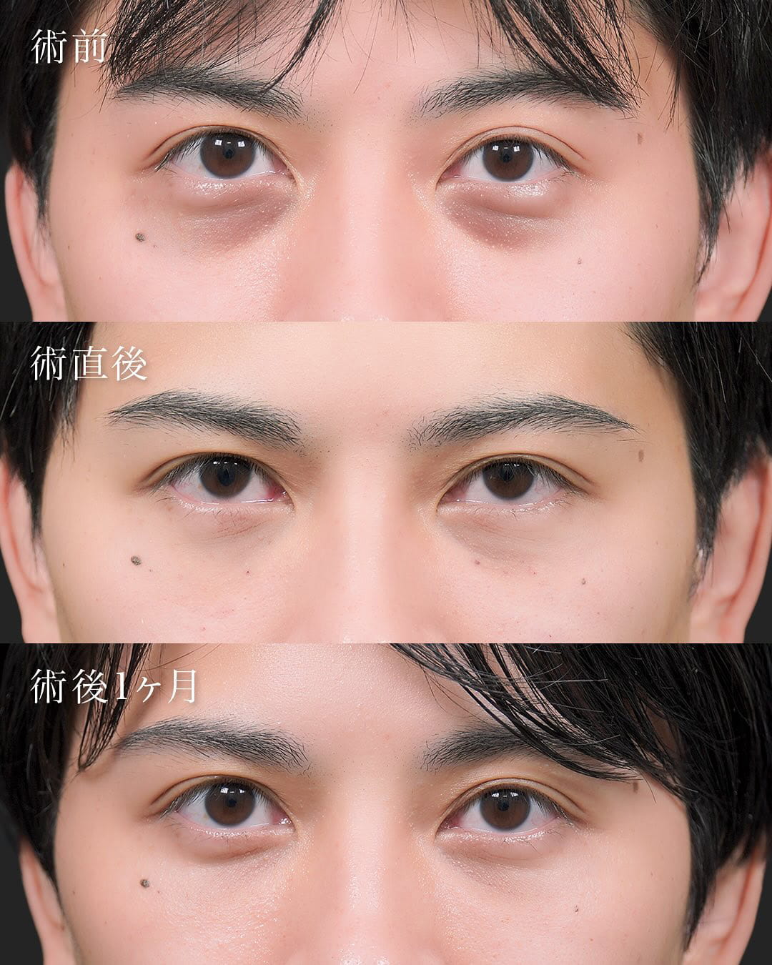 切らない目の下のクマ取り・目の下のたるみ（ふくらみ）取りの症例写真03