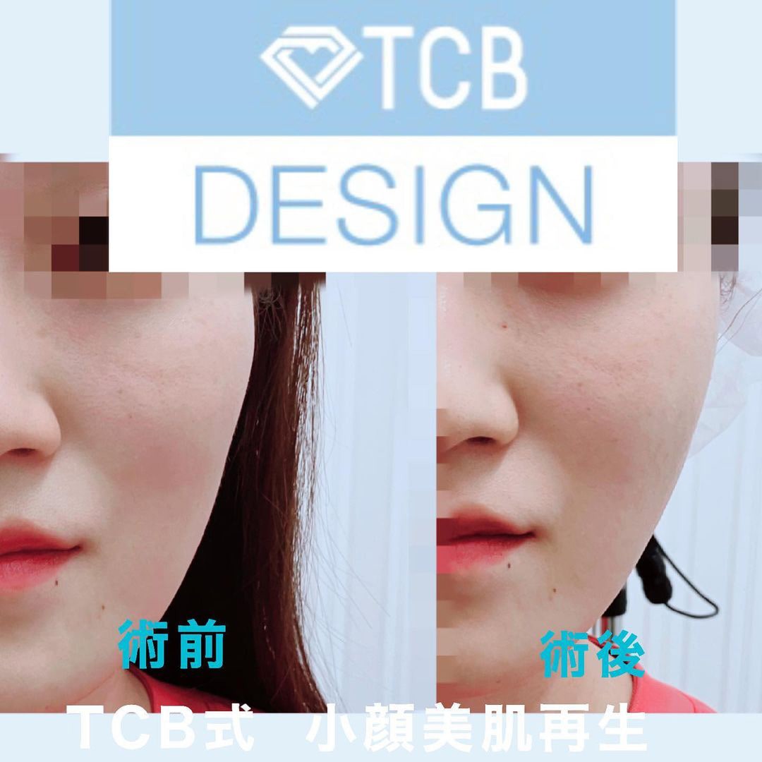 TCB式小顔美肌再生の症例写真01
