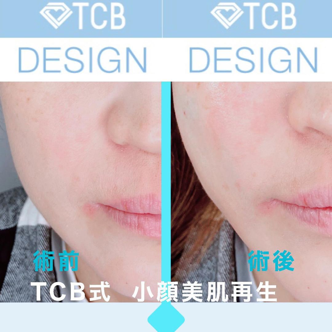 TCB式小顔美肌再生の症例写真02