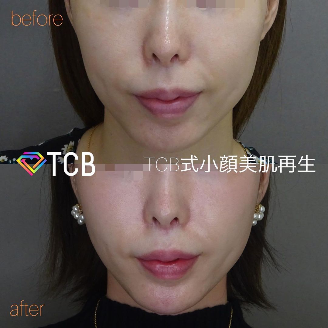 小顔美肌再生の症例写真01