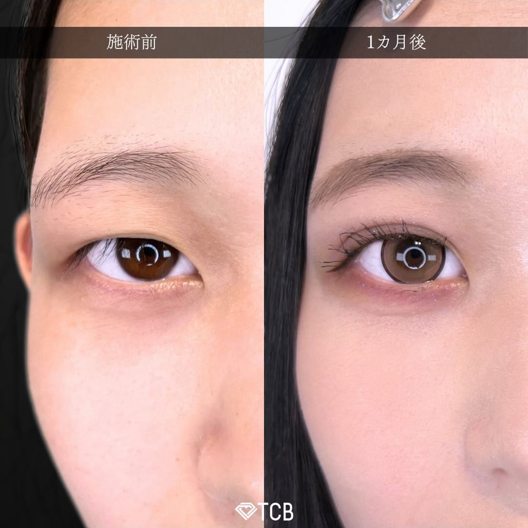 二重埋没の症例写真01