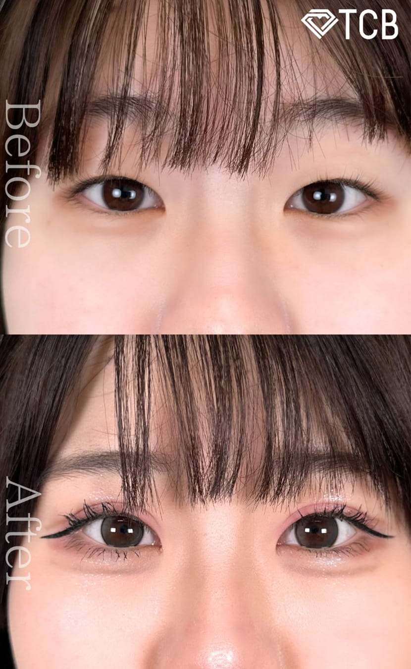 二重埋没の症例写真02