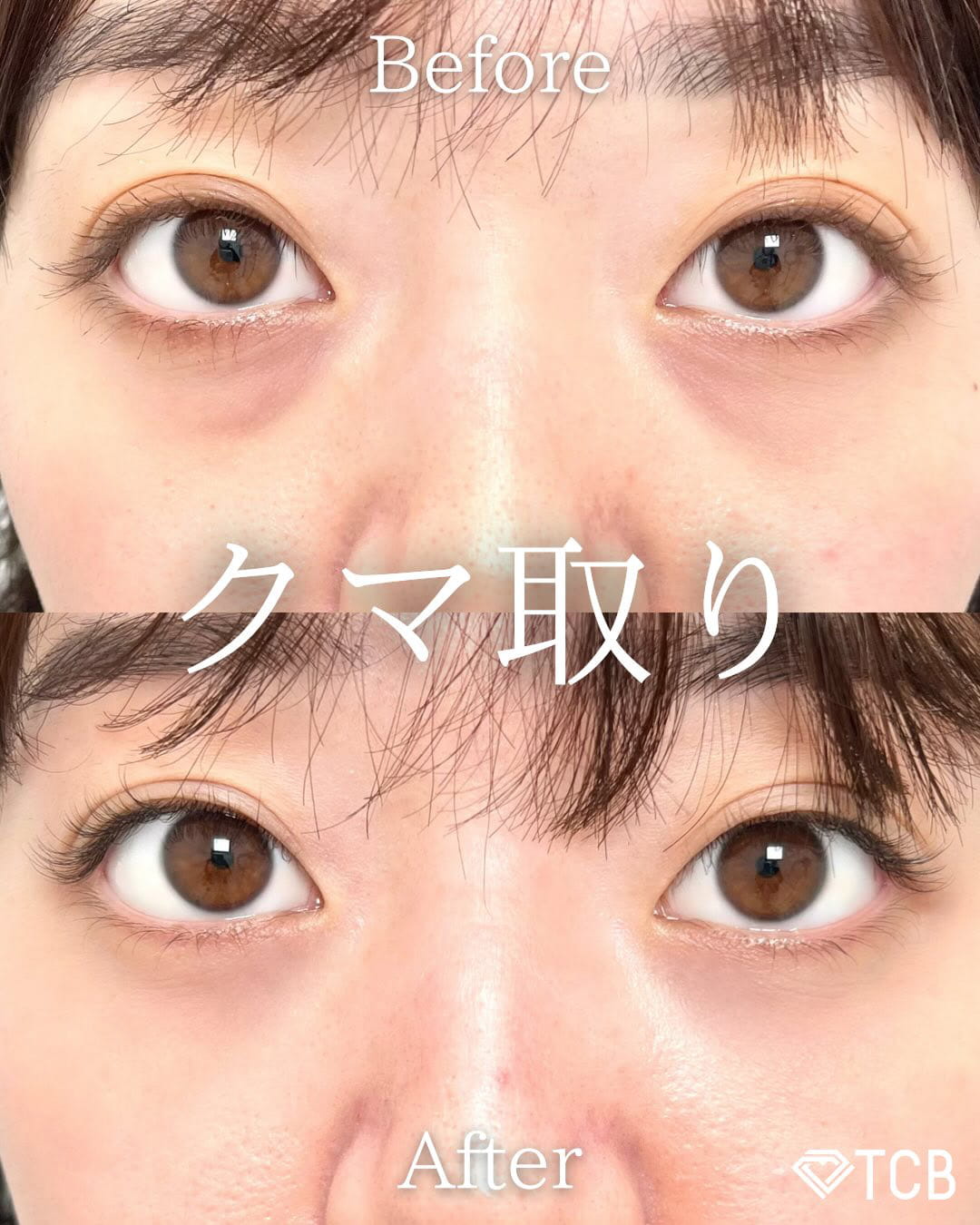 切らない目の下のクマ取り・目の下のたるみ（ふくらみ）取りの症例写真01
