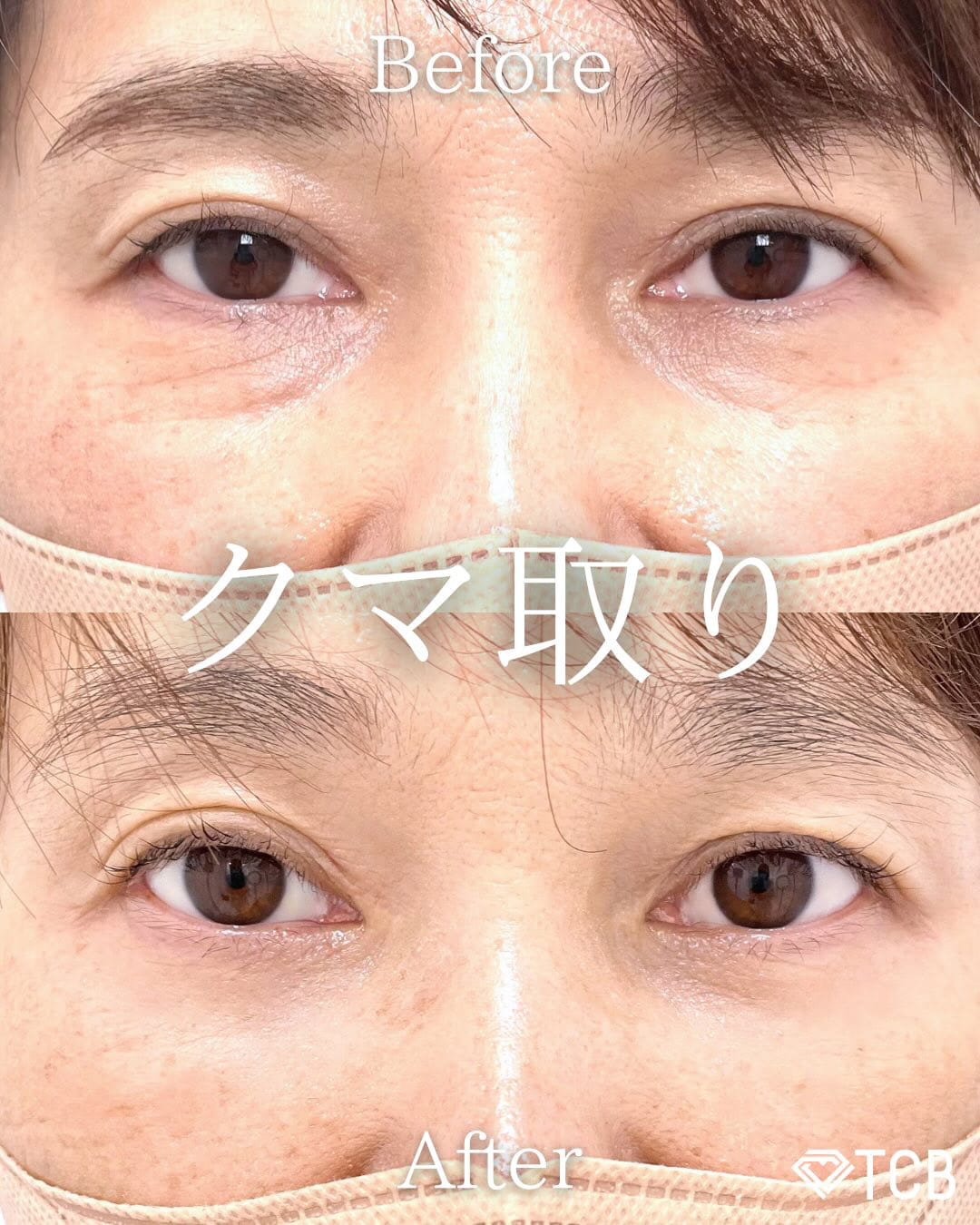 切らない目の下のクマ取り・目の下のたるみ（ふくらみ）取りの症例写真02