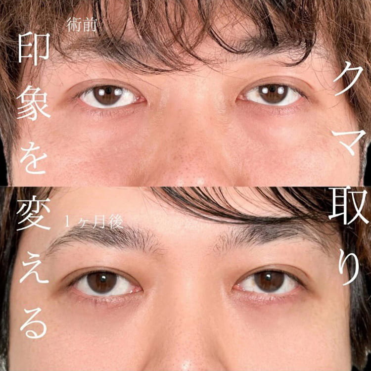 切らない目の下のクマ取り・目の下のたるみ（ふくらみ）取りの症例写真04