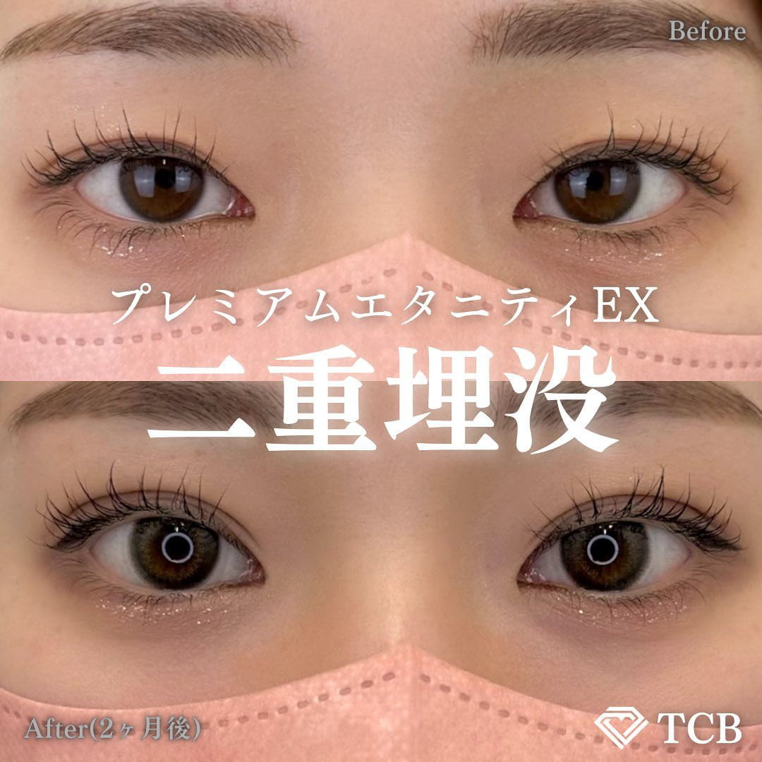 二重埋没の症例写真01