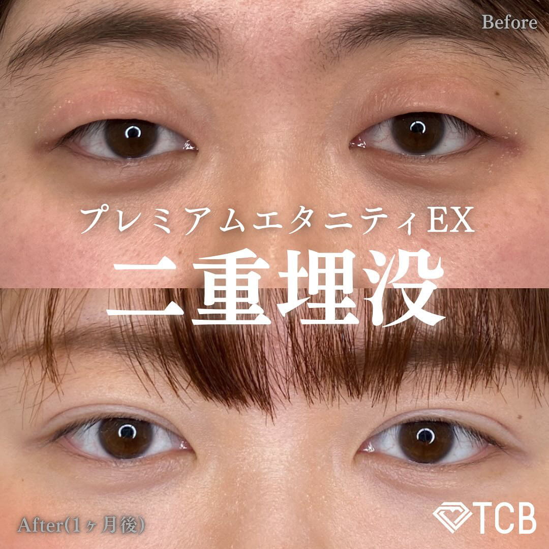 二重埋没の症例写真02