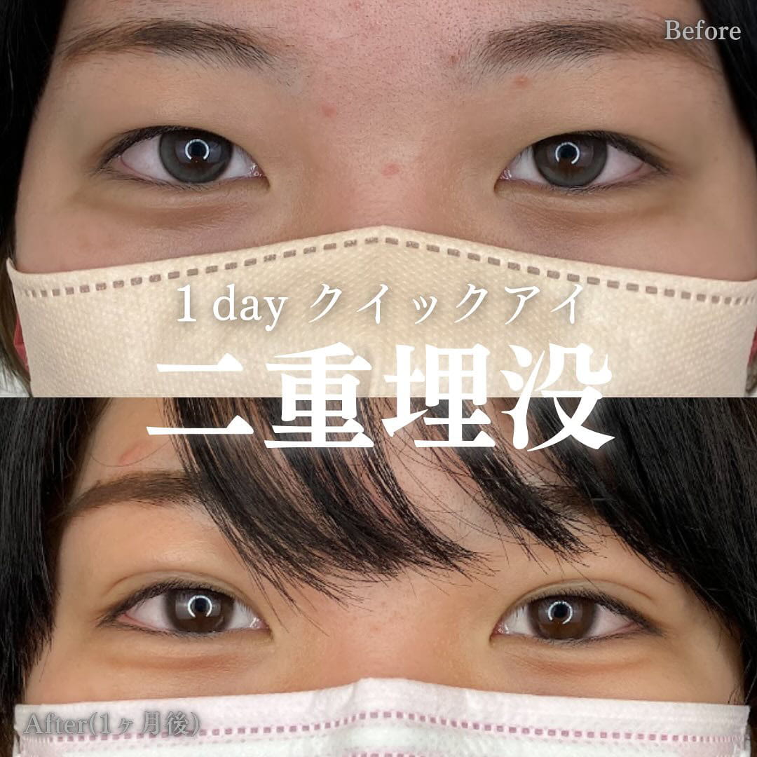 二重埋没の症例写真03