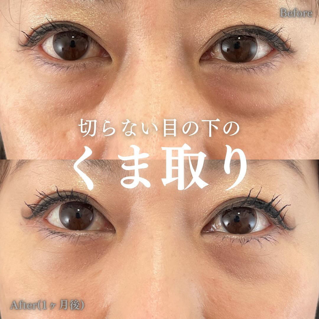 切らない目の下のクマ取り・目の下のたるみ（ふくらみ）取りの症例写真01