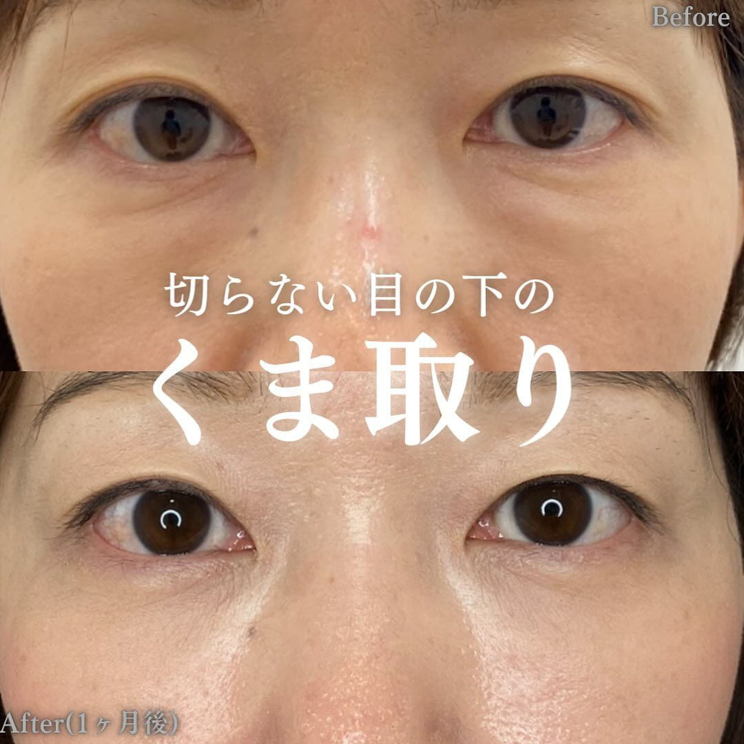 切らない目の下のクマ取り・目の下のたるみ（ふくらみ）取りの症例写真02