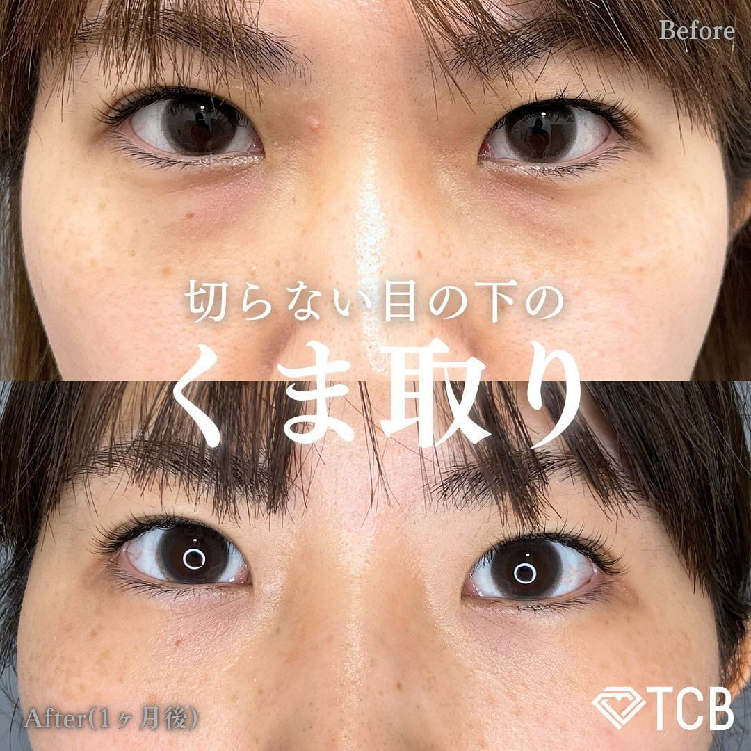 切らない目の下のクマ取り・目の下のたるみ（ふくらみ）取りの症例写真03